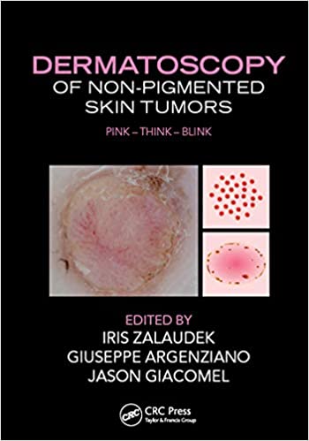 Dermatoscopy of Non-Pigmented Skin Tumors (Pink - Think - Blink) - eBook