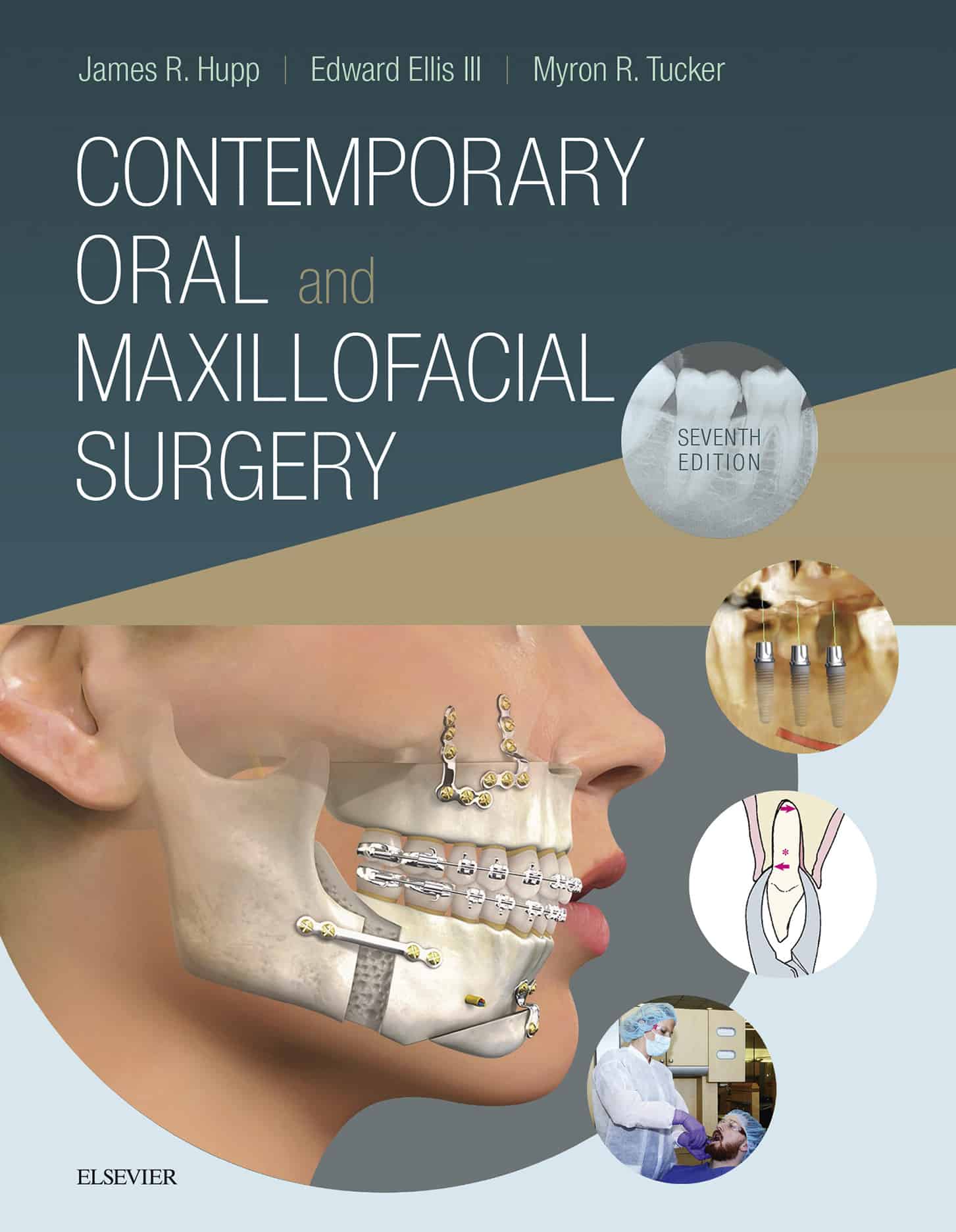 Contemporary Oral and Maxillofacial Surgery (7th Edition) - eBook